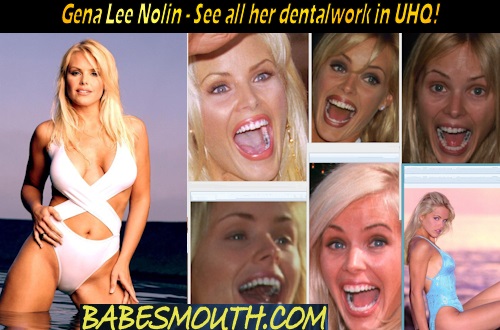 Gena Lee Nolin Amalgam Fillings