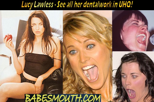 Lucy Lawless Amalgam Fillings