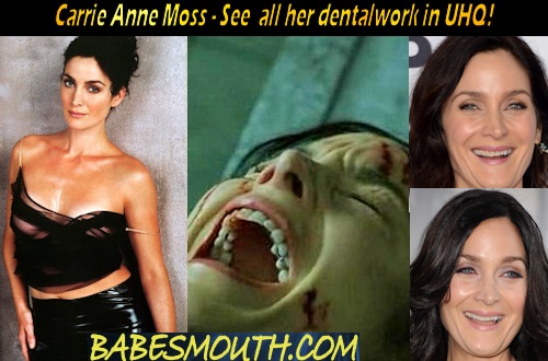 Carrie Anne Moss Amalgam Fillings