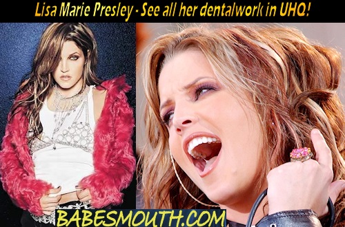 Lisa Marie Presley Amalgam Fillings