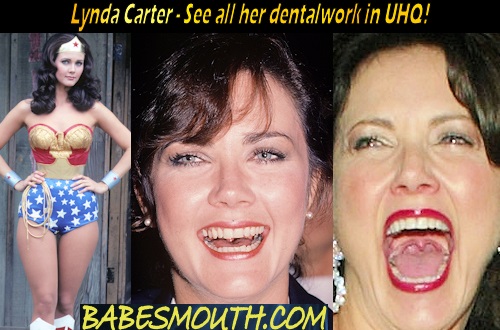 Lynda Carter Amalgam Fillings