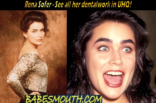 Rena Sofer Smile, Amalgam Fillings